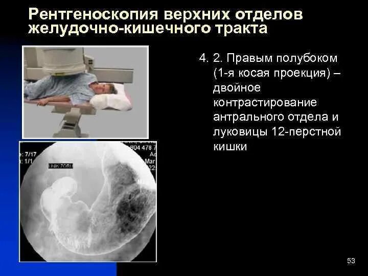 Рентгеноскопия жкт. Рентгеноскопия жкт