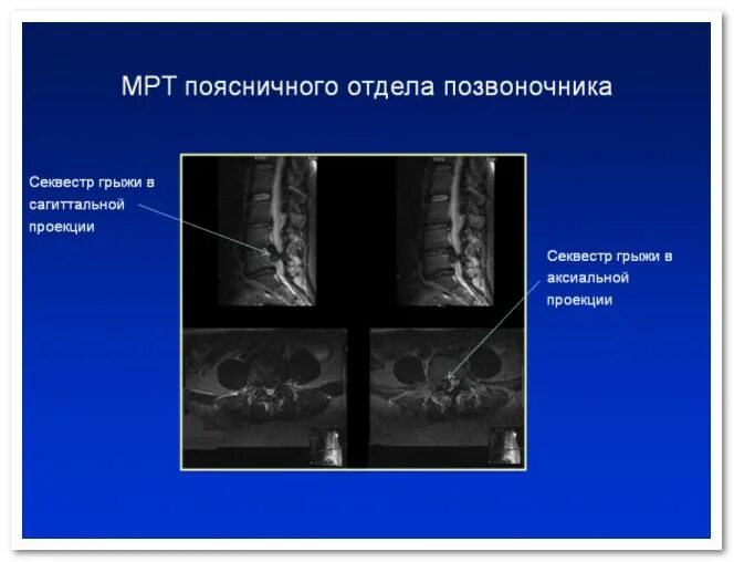 Остеохондроз шейного и поясничного отдела позвоночника. Грыжа поясничного отдела мрт. Грыжа позвоночника поясничного отдела. Диагноз грыжи поясничного отдела. Диагноз грыжи поясничного отдела.