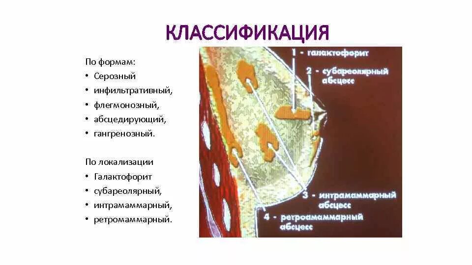 Классификация лактационного мастита. Острый Гнойный мастит классификация. Мастит серозный инфильтративный Гнойный. Мастит классификация хирургия. Острый гнойный мастит