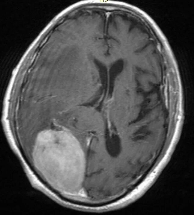 Brain 28. Опухоль головного мозга Синюшина.