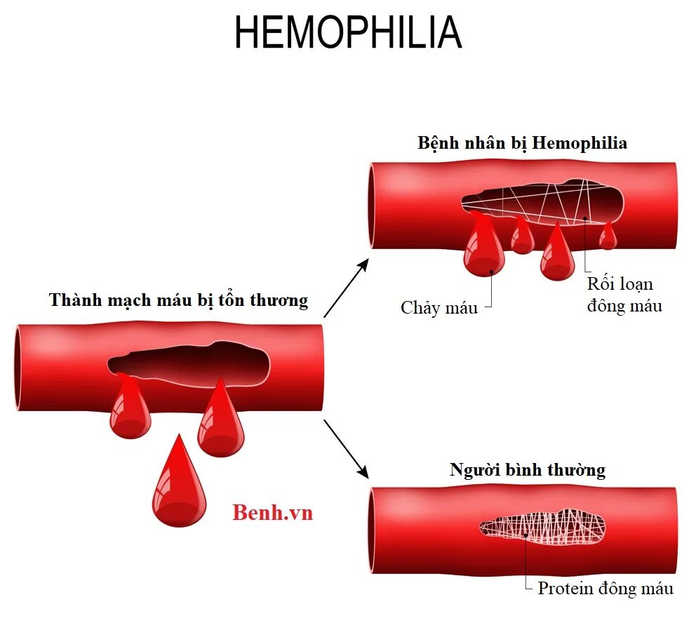 Гемофилия h