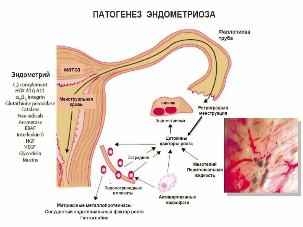 При аденомиозе можно забеременеть. Ретроцервикальный эндометриоз патогенез. Механизм развития эндометриоза. Патогенез наружного генитального эндометриоза. Этиология внутреннего эндометриоза.