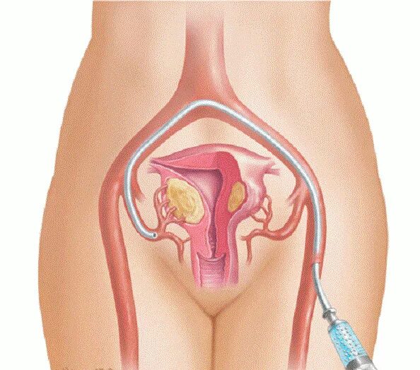 Эмболизация миомы матки. Женская анатомия. Женский половой орган.