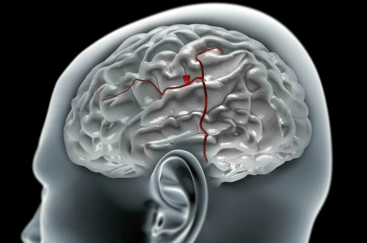 Аневризма сосудов мозга. Аневризма артерии головного мозга. Аневризм сосудов головного мозга. Микроаневризма сосудов головного мозга. Аневризма мозга простыми словами