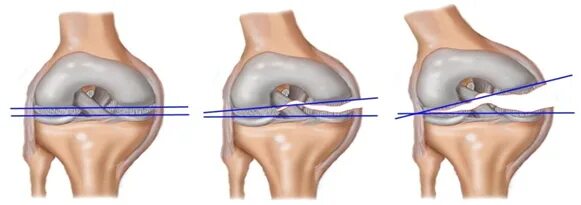 Разрыв мениска коленного сустава. Мениск разрыв мениска симптомы. Разрыв мениска коленного симптомы. Отрыв мениска коленного сустава.