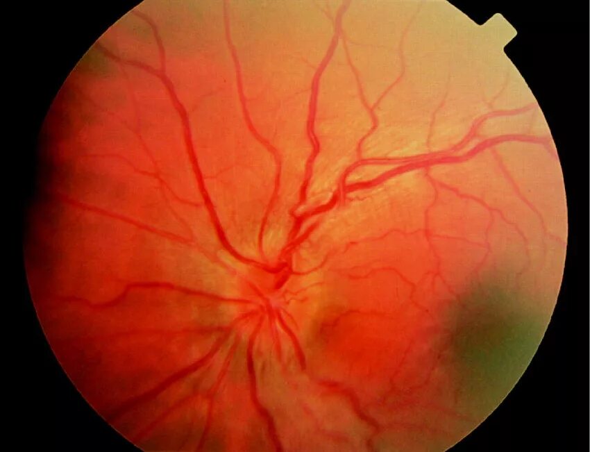 Синдром амавроз лебера. Вторичная постзастойная атрофия зрительного нерва. Между геном атрофии зрительного нерва. Наследственная оптическая нейропатия лебера. Атрофирование глазного нерва.