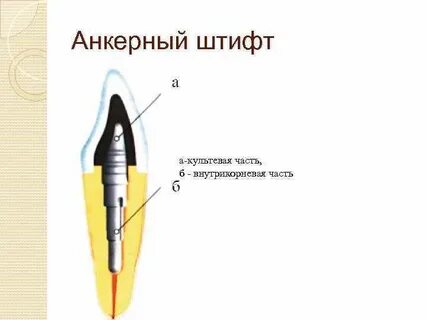 Культевые штифтовые вкладки