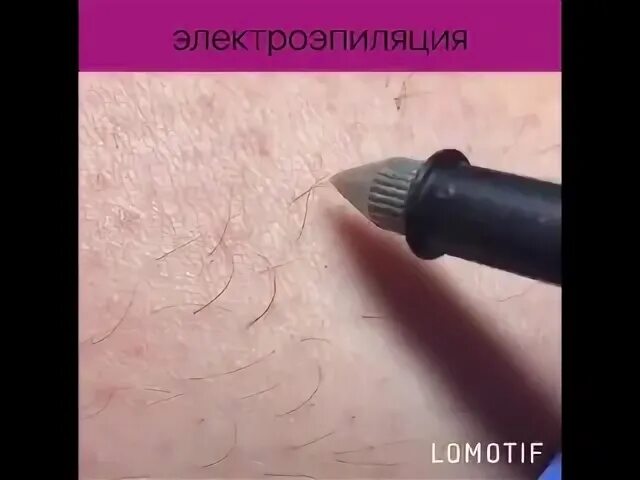 Электроэпиляция это больно