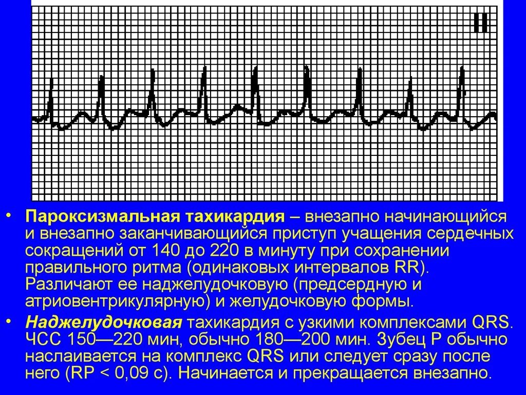 Что делать при тахикардии в домашних условиях. Синусовая тахикардия ЧСС 140. Параксизмальнаятахикардия. Пароксизмальная тахикардия. Приступ пароксизмальной тахикардии.