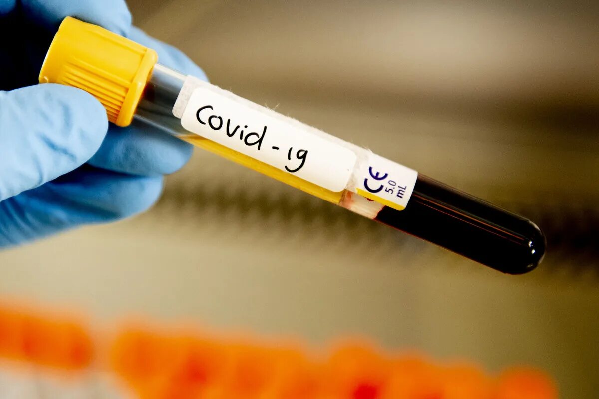 Лечение коронавируса человека препараты. Тест на коронавирус. Фотосток коронавирус. Тест на коронавирус картинки. Анализ крови фото.