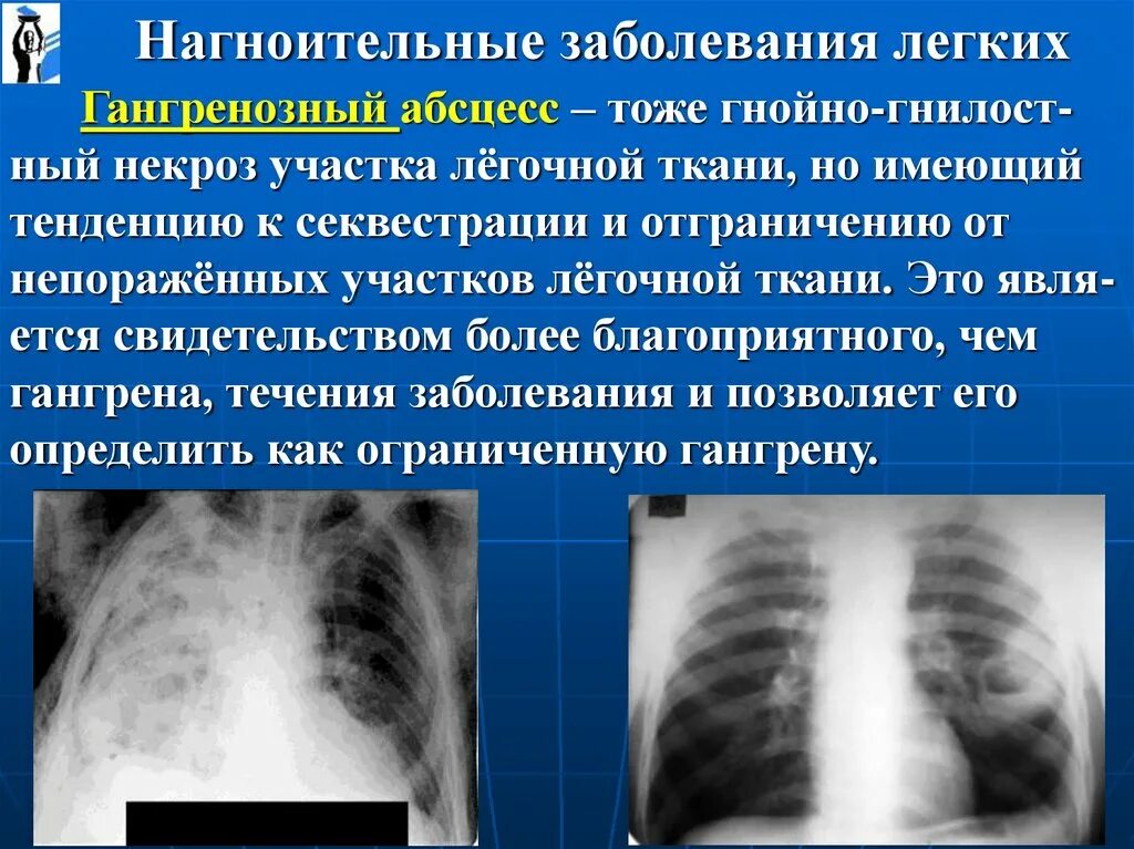 Поражение легких лечение. Заболевание легких список. Нагноительные заболевания легких. Заболевания легких названия.