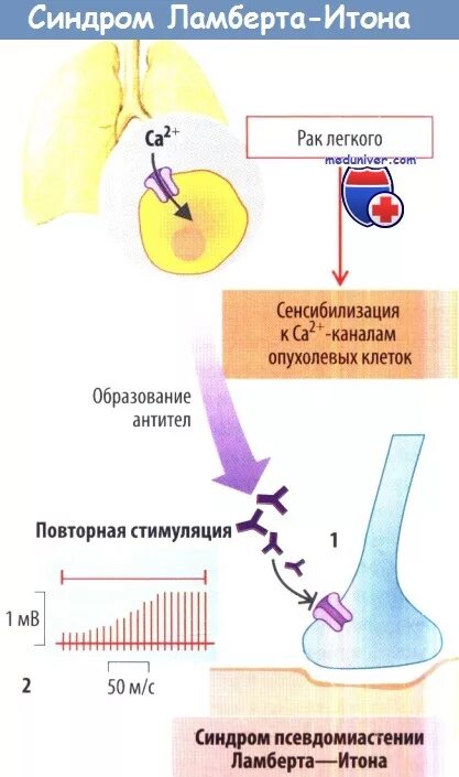 Синдром ламберта итона. Синдром ламберта итона патогенез. миастения ламберта итона. миастенический синдром ламберта-итона симптомы. синдром ламберта-итона (миастенический синдром).