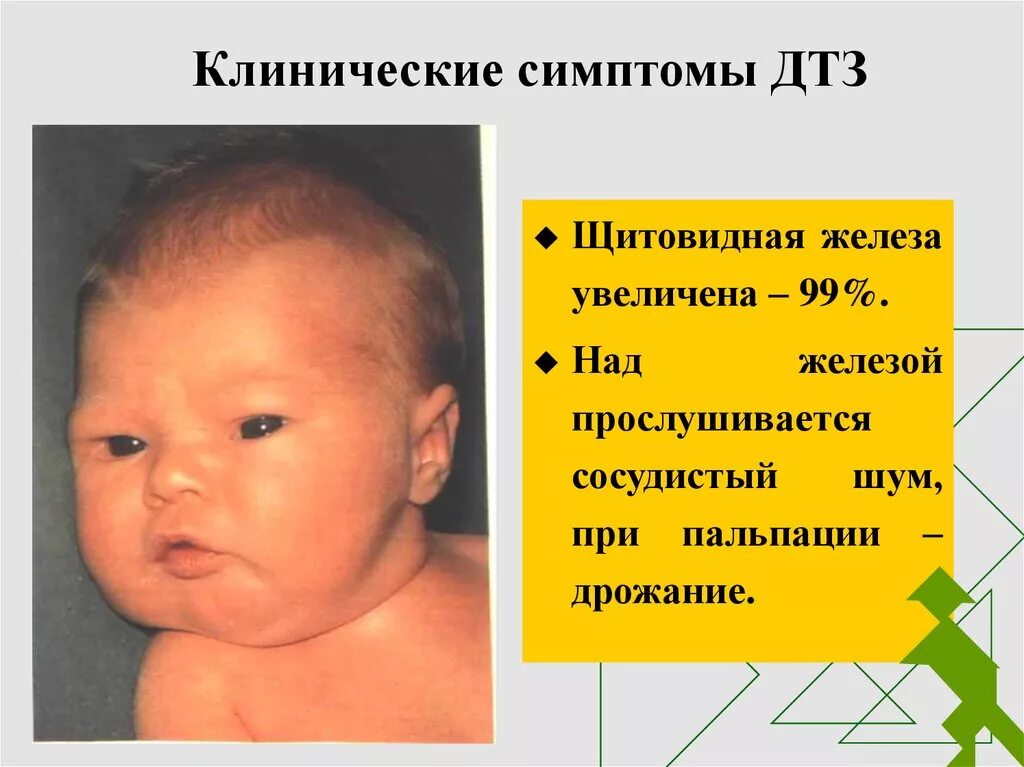 Изменение щитовидной железы у ребенка. Врожденный гипотиреоз клинические проявления. Заболевания щитовидной железы у детей. Транзиторный гипотиреоз у новорожденных. Гипо ыункция шитовидной желевщв у детей.