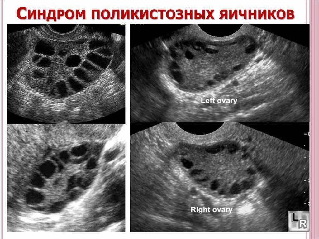 Поликистозные яичники лечение. Синдром поликистоза яичников на УЗИ. Фолликулярный поликистоз яичников. Снимок УЗИ поликистоз яичников. Мультифолликулярные поликистоз яичников.