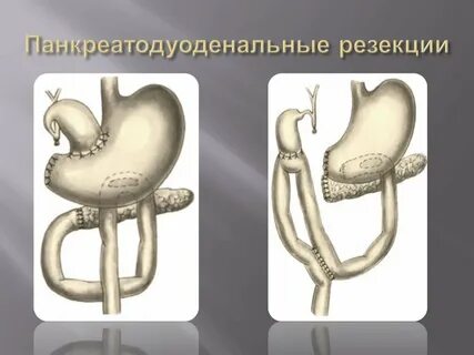 Без резекции