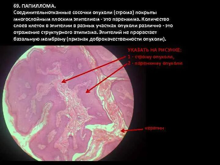 Опухоль с преобладанием стромы на ощупь