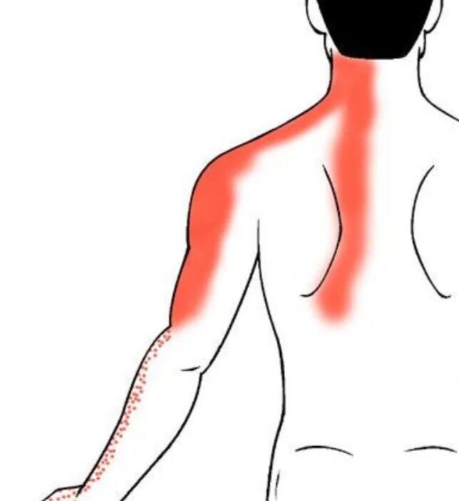 Болит правая лопатка и отдает в руку. Болит левое плечо. Боль в левой лопатке.