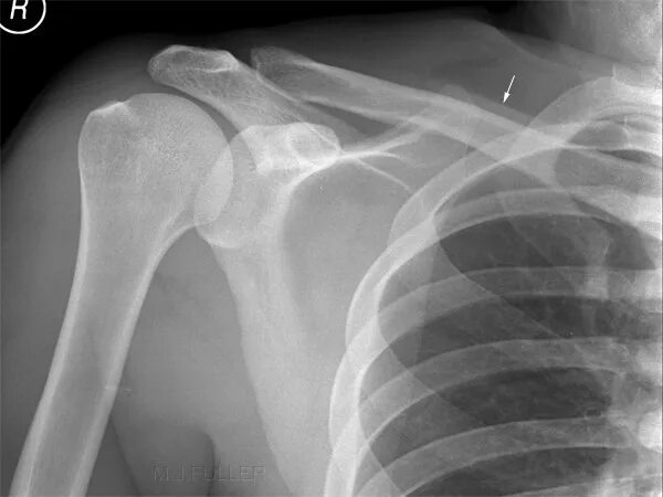 Полный вывих акромиального конца ключицы. Акромиальный отросток ключицы перелом. Вывих акромиально-ключичного сочленения. Повреждение акромиально-ключичного сочленения рентген. Подвывих ключицы рентген.