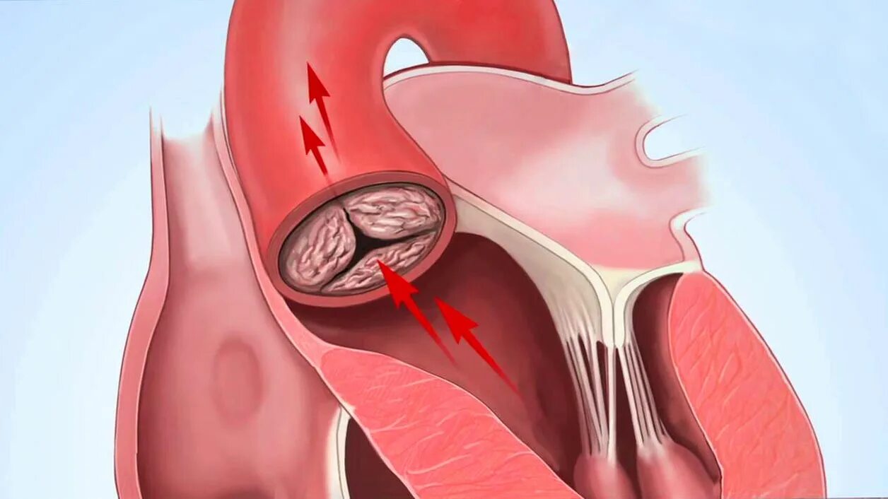 Кальциноз митрального клапана. Стеноз аортального клапана. Сужение аортального клапана.