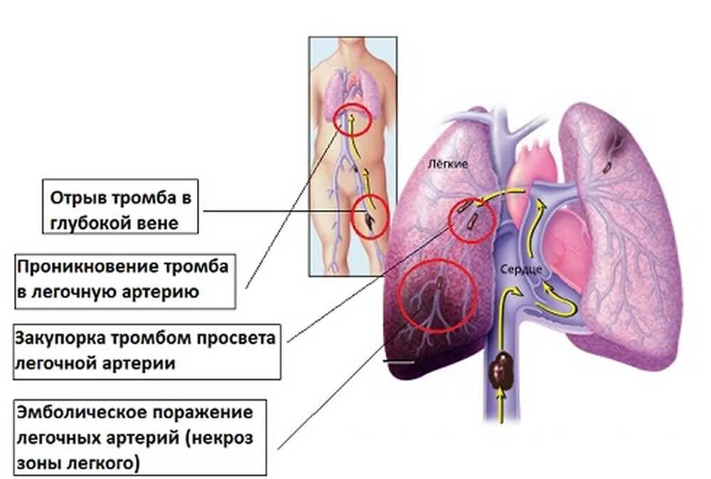 Закупорка тромбом легочной артерии. Закупорка легочных сосудов. Тромб из легочной артерии. Тромбофлебит легочной артерии