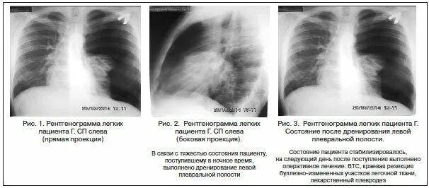 Признаки повреждения легких. Рентген картина пневмоторакса. Пневмоторакс боковая проекция рентген. Пневмоторакс клинические рекомендации. Пневмоторакс при туберкулезе легких.