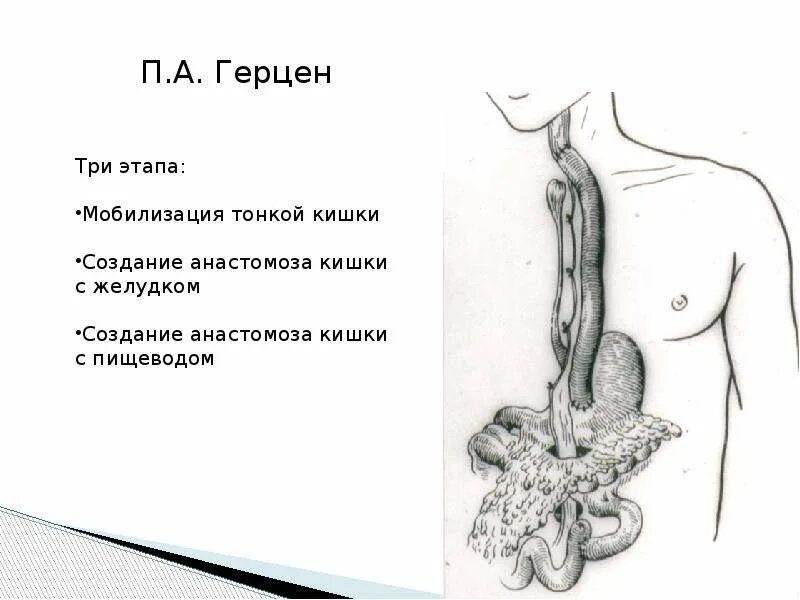 Пластика пищевода по ру-Герцену-Юдину. Эзофагопластика тонкой кишкой. Пластика пищевода тонкой кишкой. Пластика пищевода тонкой кишкой по ру-Герцену-Юдину.