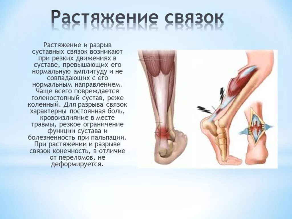 Разрыв и растяжение. Разрыв связок голеностопного сустава мкб 10. Растяжение связок анатомия. Растяжение и разрыв связок происходят,.