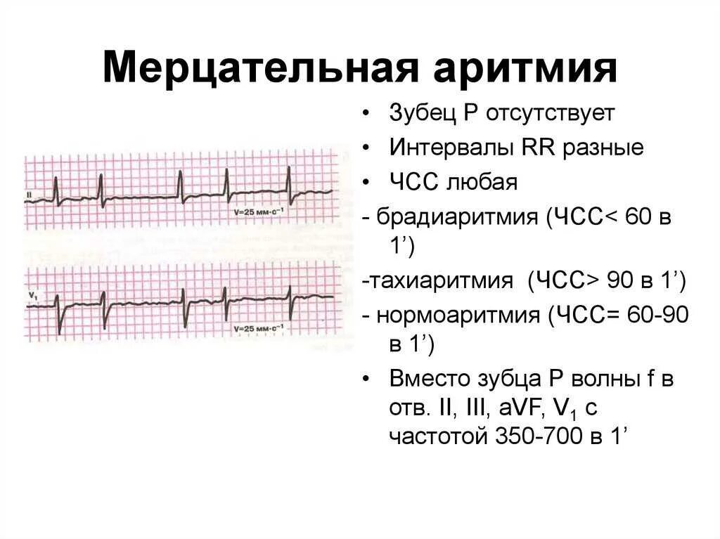 Мерцательная аритмия фибрилляция предсердий симптомы. Признаки мерцательной аритмии на экг. мерцательная аритмия на экг с расшифровкой. синусовая мерцательная аритмия экг. экг при мерцательной аритмии.