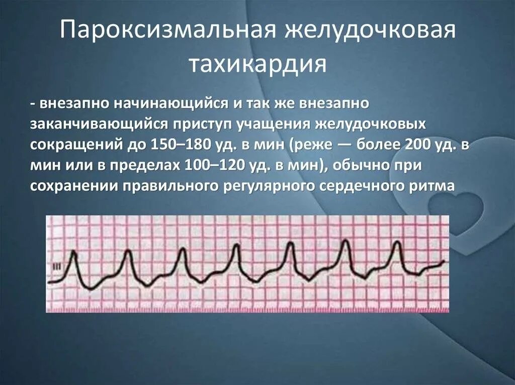 Пароксизм это простыми словами. Пароксизмальная желудочковая тахикардия на ЭКГ. Пароксизмальная наджелудочковая тахикардия ЭКГ. Пароксизмальная тахикардия ЭКГ. Пароксизмальная тахикардия ЭКГ признаки.