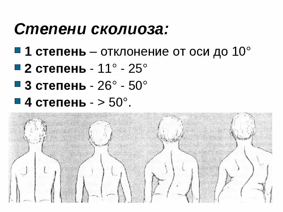 Искривление позвоночника градусы. Правосторонний с образный сколиоз 2 степени. S образный сколиоз 2 степени грудопоясничного отдела. Левосторонний грудной сколиоз 1 степени. S образный грудопоясничный сколиоз 2 степени массаж.