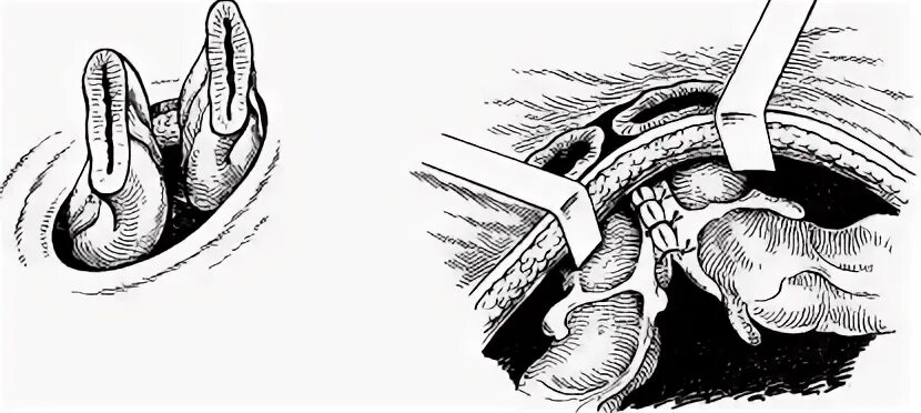 Пилоропластика гейнеке-микуличу. Резекция по микуличу. Эвентрация петель толстого кишечника. Операция микулича двуствольная колостома. Дренирующие операция по гейнеке-микуличу.