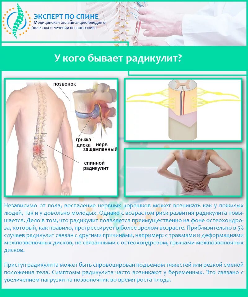 Радикулит симптомы у мужчин лечение. Радикулит симптоматика. Симптомы радикулита поясничного отдела. Радикулит спины симптомы. Радикулит причины возникновения.