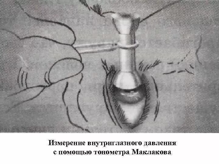 Тонометрия (измерение глазного давления). Внутриглазное давление тонометр Маклакова. Измерение внутриглазного давления тонометром Маклакова. Тонометр глазного давления по маклакову.