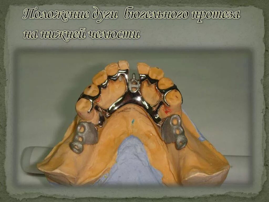 Моделирование базиса бюгельного протеза. Паянный бюгелный протес. Бюгельный протез (2-3 кламмера). Что такое бюгельный протез в стоматологии. 002.