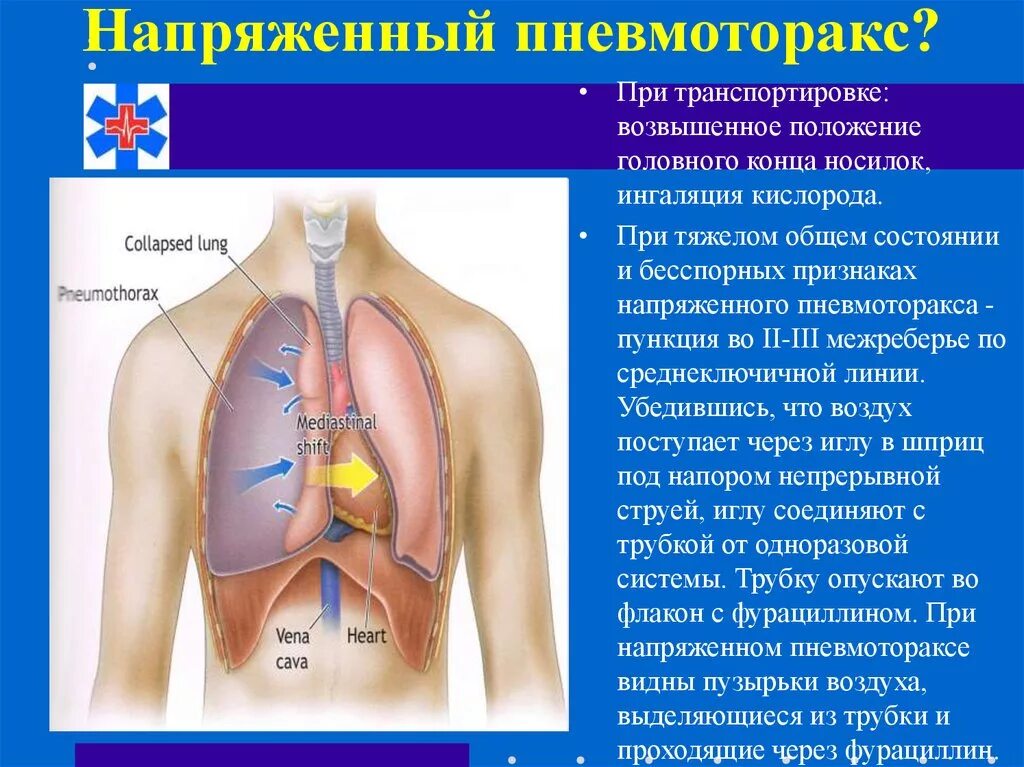 Pneumothorax