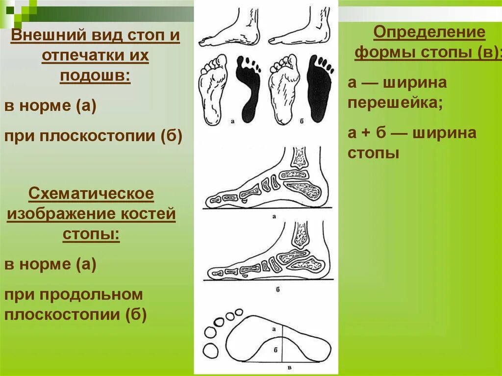 Общество подошв. Нормальная стопа. Нормальная стопа и плоскостопие. Форма стопы плоскостопие. Плоскостопие норма.