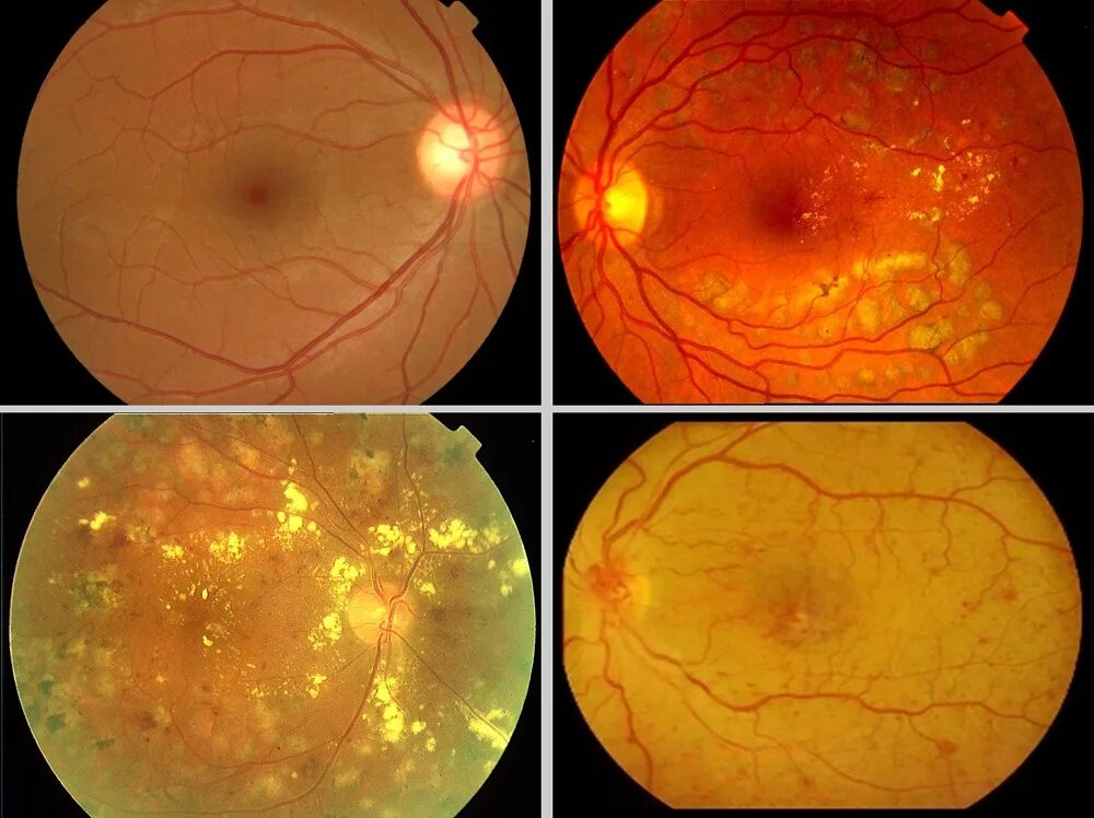 Макулярный отек лечение. Диабетическая ретинопатия глаз. Дегенерация центральной сетчатки глаза. Мелкокистозная дистрофия сетчатки. Хориоретинальная дегенерация сетчатки.