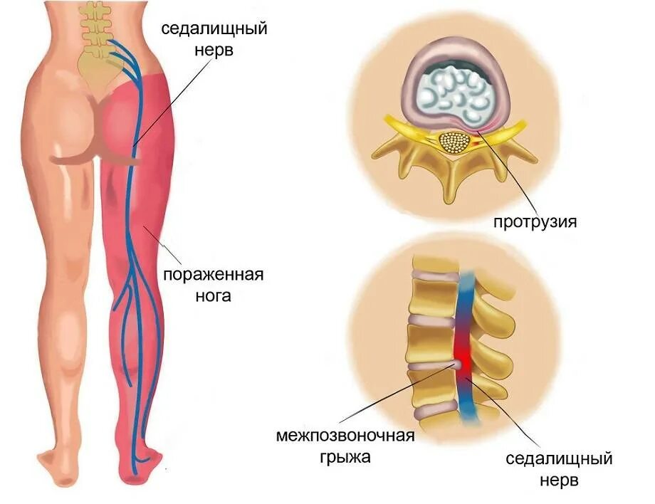 Седалищный нерв локализация. Воспалился седалищный нерв. Поражение седалищного нерва симптомы.