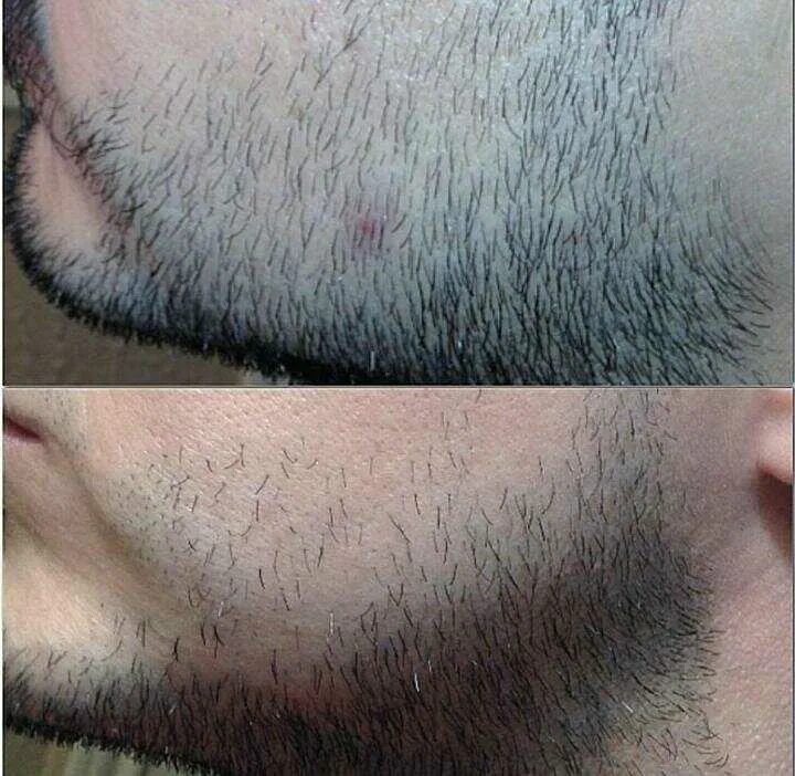 Рост волос на лице у мужчин. Генеролон миноксидил 5 для бороды. Средство для отращивания бороды миноксидил. МАЗ для борода миноксидил. Миноксидил 5 процентный для бороды.