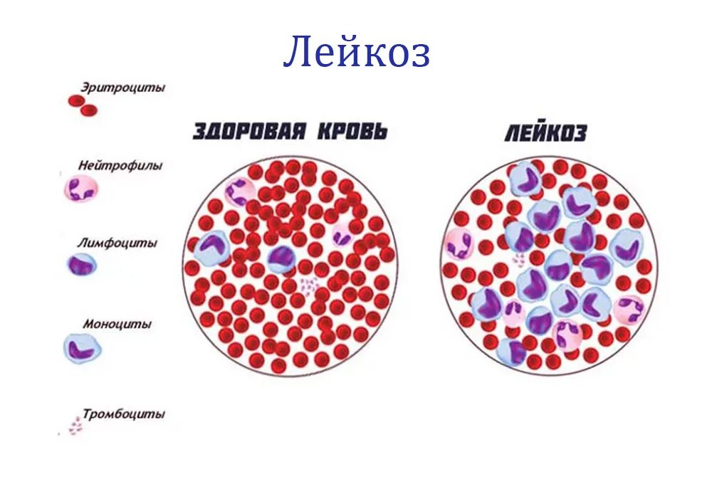 Злокачественные заболевания крови. Кровь здорового человека. Кровь человека при лейкозе.