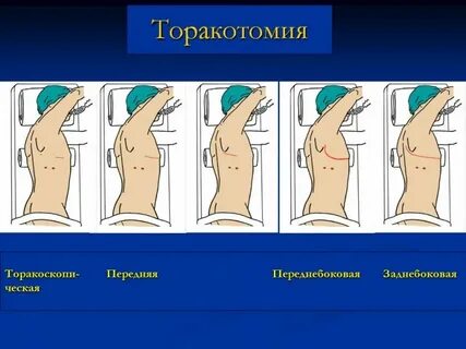 Торакотомия