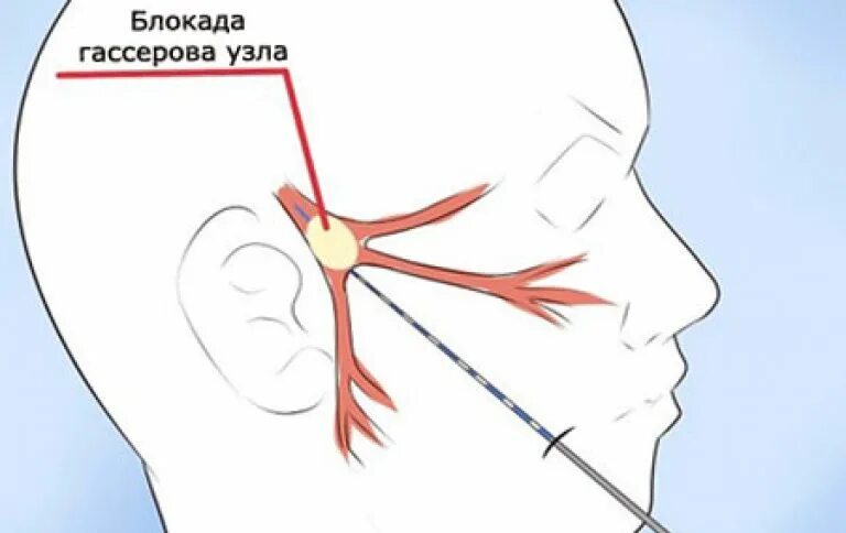 Блокада узла. Блокада тройничного нерва техника. Блокада гассерова узла. Тройничная невралгия блокада. Блокада узла тройничного нерва.