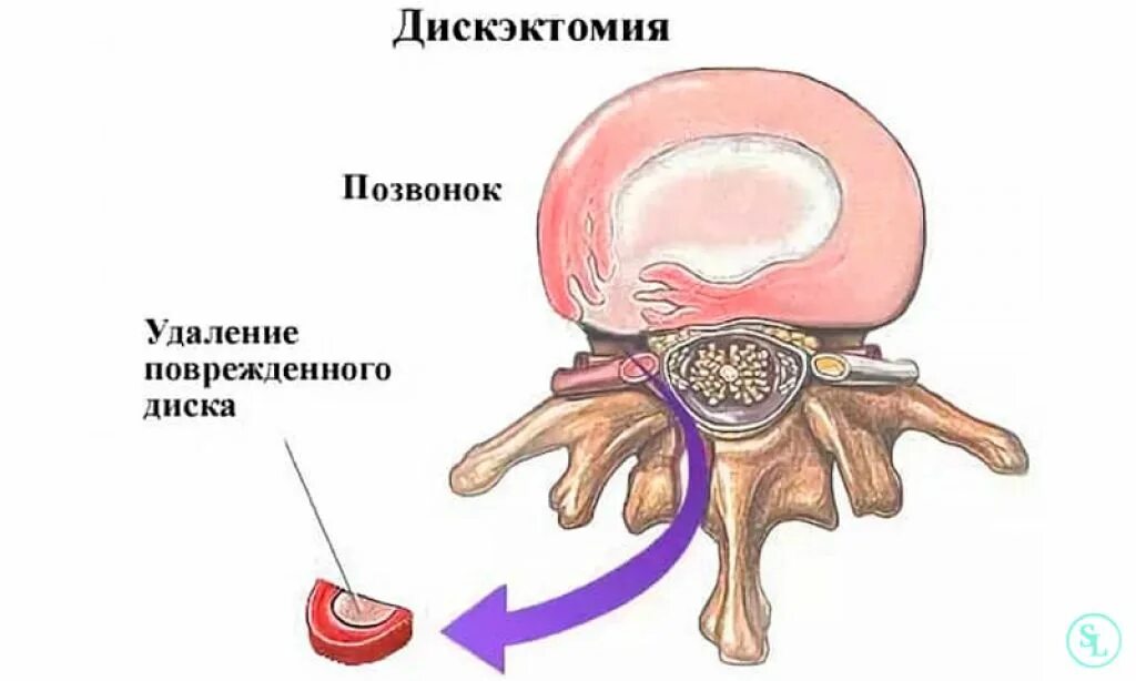 Удаление грыжи в пояснице. Микродискэктомия грыжи позвоночника. Микродискэктомия поясничного отдела позвоночника l5-s1. Грыжа межпозвонкового диска операция. Дискэктомия шейного отдела позвоночника с5-с6.