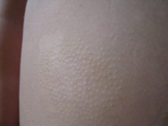 Небольшие розовые пятна на коже. Прозрачные пятна на руках. Коричневые пятнышки на коже. Отрубевидный лишай - pityriasis versicolor (tinea versicolor). Высыпания на теле у ребенка.