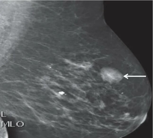 Маммография фиброаденома. Фиброзно-кистозная мастопатия биопсия. Злокачественная фиброаденома молочной железы. Атипичная фиброаденома маммография. Фиброаденоматоз bi