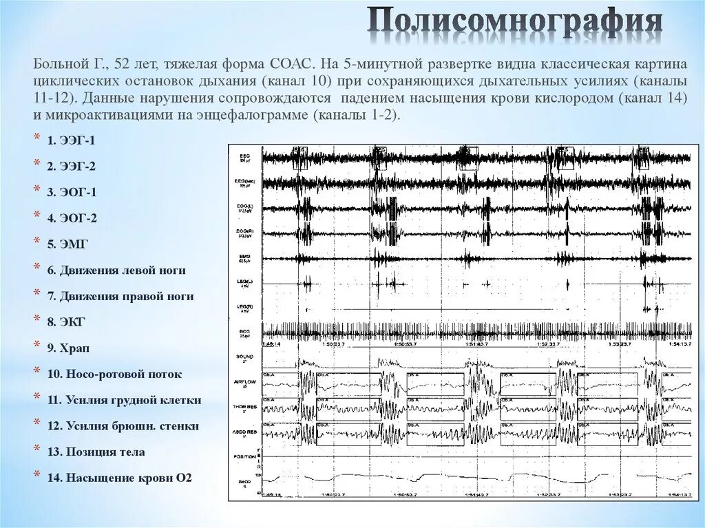 Ээг по омс. Полисомнография. Полисомнографическое исследование сна. Полисомнография Результаты. Стационарная полисомнография.