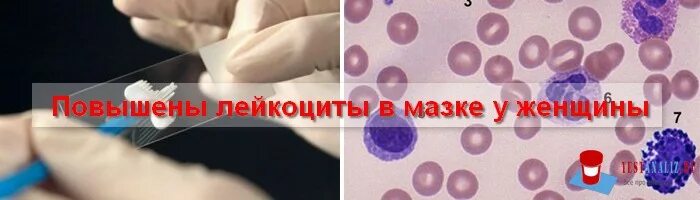 Почему в мазке повышены лейкоциты у женщин. Мазок лейкоциты повышены. Лейкоциты в мазке повышены. Лейкоциты в мазке повышены причины. Выделения при повышенных лейкоцитах в мазке.