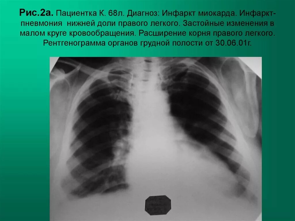 Пневмония в правой нижней доле. Инфаркт-пневмония легкого рентген. Инфаркт лёгкого на рентгенограмме. Инфарктная пневмония на рентгенограмме. Застойные явления в легких рентген.