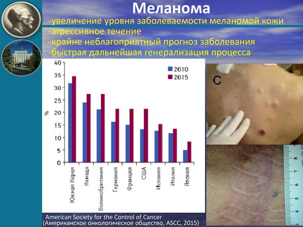 статистика заболеваемости меланомой в россии. статистика заболевания меланомой в россии. статистика заболевания меланомой. меланома статистика. статистика заболеваемости меланомой кожи.