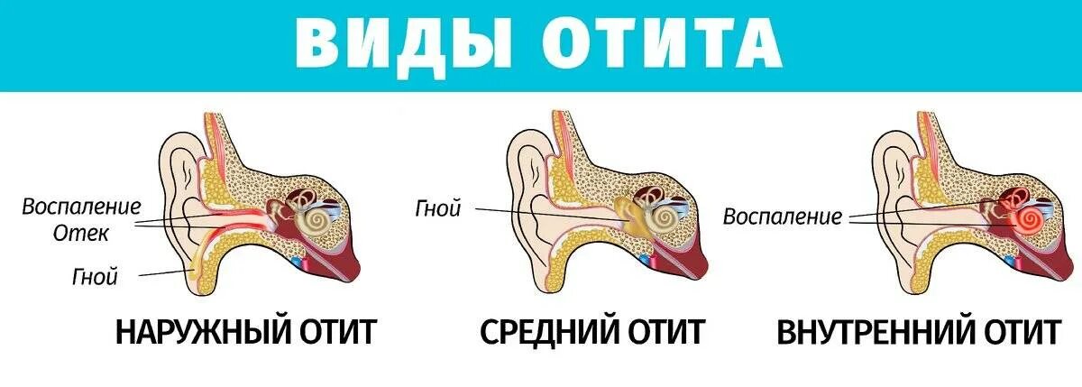 Как избавиться от заложенности уха. Острый Гнойный перфоративный отит. Как выглядит острый наружный отит. Острый наружный отит ухо.